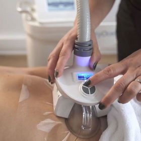 cryolipolyse aspiration refroidissement 71824df2